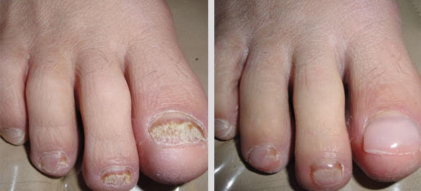 KeryFlex nail restoration before and after